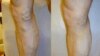 FILE: Unyawo olulesifo sevaricose veins lokwenzakala ungelatshwa