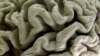 Large Study Details Years of Brain Changes in Alzheimer’s Patients